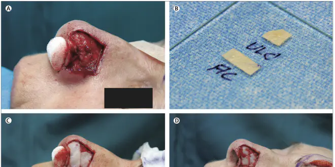 Les étapes de la greffe. (A) ouverture du nez, (B) les élements à greffer, (C) & (D) implantation ; (E) après la fin de l'opération ; (F) une semaine après l'opération ; (G) examen de contrôle à six mois ; (H) un an après l'opération (Crédits: The Lancet)