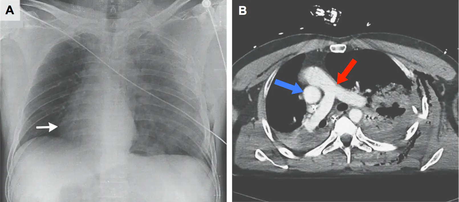 Radio et scanner révélant la rotation du coeur. (crédit : NEJM)