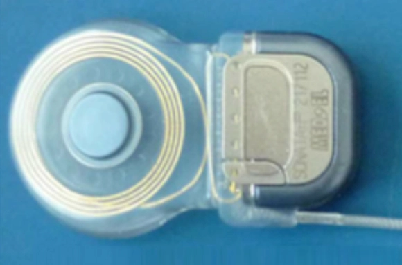 Implant cochléaire modifié pour stimuler le nerf vestibulaire.