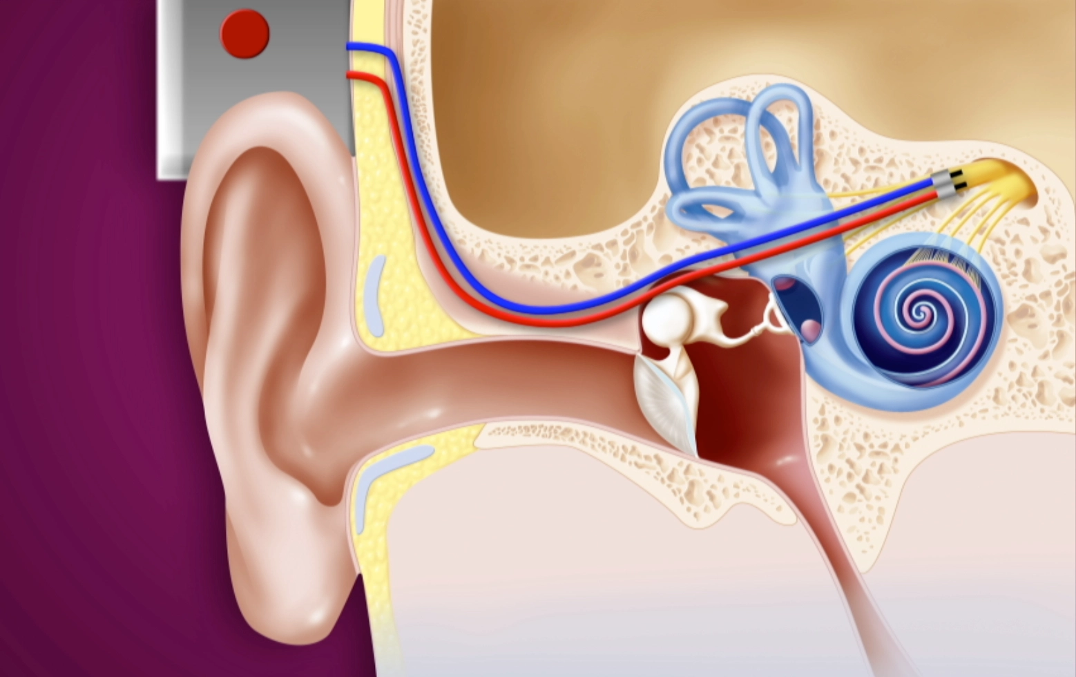 Implantation du dispositif. (Crédits : le Magazine de la Santé/Allodocteurs.fr)