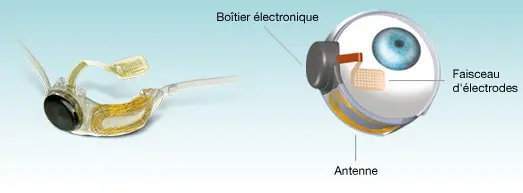 La prothèse est implantée à l'intérieur et autour de l'œil par voie chirurgicale. Elle comprend une antenne, un boîtier électronique et un faisceau d'électrodes. Crédit : Second Sight.