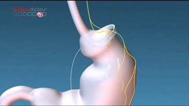 La chirurgie de l’obésité