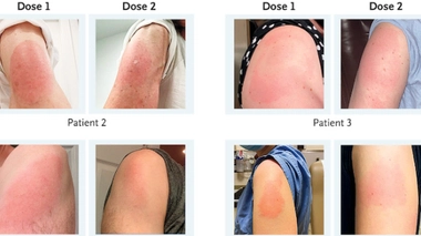 Vaccin Moderna : la survenue d’un "bras covid" doit-elle inquiéter ?