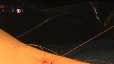 Appendicite : gare à la péritonite