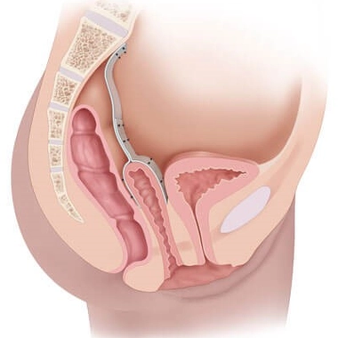 Prolapsus : quand les organes descendent