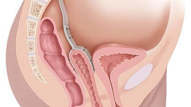 Prolapsus : quand les organes descendent