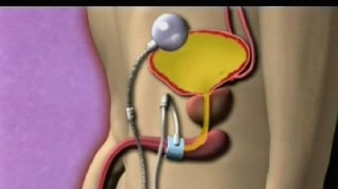 Ch@t : Incontinence urinaire