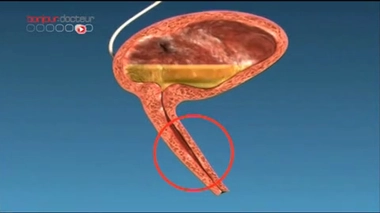 Un urètre reconstruit en laboratoire
