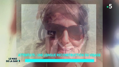 Attentats : la longue reconstruction du visage de Gaëlle, blessée au Bataclan