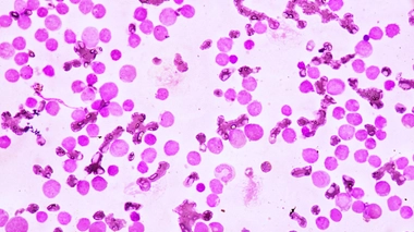 La leucémie myéloïde chronique, un cancer du sang et de la moelle osseuse