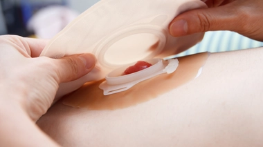 La stomie : un court-circuit dans la digestion