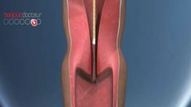 Ch@t : Stérilet, mode d'emploi