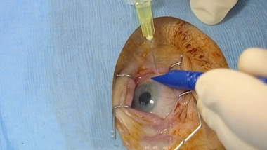 Un nouveau médicament pour soigner la DMLA