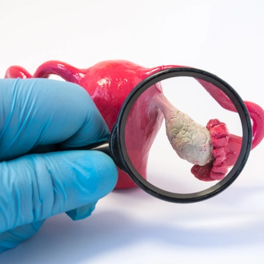 Ovaires polykystiques : un syndrome fréquent