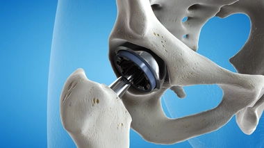 Comment se déroule la pose d'une prothèse de hanche ?