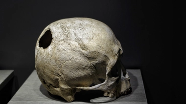 Qu'est-ce que la trépanation ?