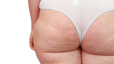 Comment se débarrasser... des boutons sur les fesses ?