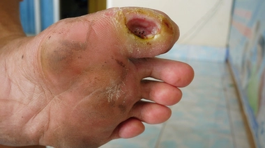 Diabète : pourquoi il faut surveiller ses pieds