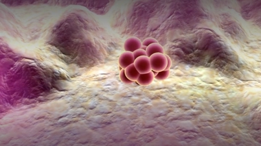 Maladie de von Hippel-Lindau : combattre ces tumeurs qui envahissent les reins