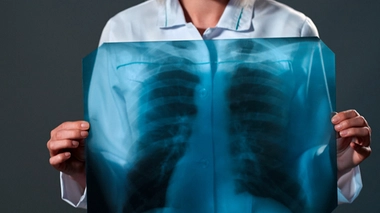 Le cancer du poumon en augmentation chez les femmes et les non-fumeurs