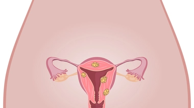 Etes-vous incollable sur le fibrome ?