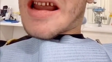 “Dents de requin”, la tendance des influenceurs qui inquiète les médecins