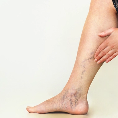 Varices : quand les veines s'emmêlent