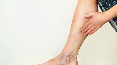 Varices : quand les veines s'emmêlent