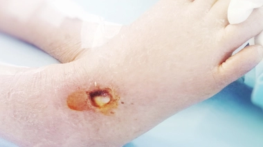 Comment soigner les escarres ?