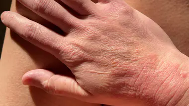 Addiction à la cortisone : y'a-t-il un danger à utiliser les crèmes à base de corticoïdes ?