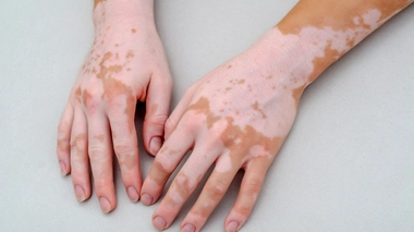 Tout savoir sur le vitiligo