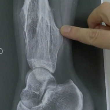 Exostose osseuse : des bosses sous la peau