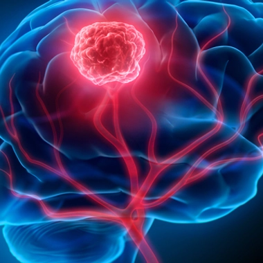 Une tumeur dans le cerveai