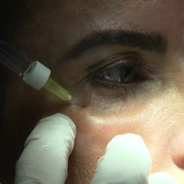 Rides : des crèmes aux injections