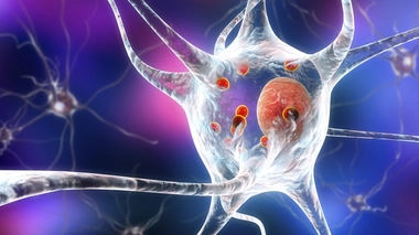 Maladie à corps de Lewy : une démence mal diagnostiquée