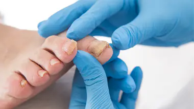 Débarrasser les ongles des mycoses