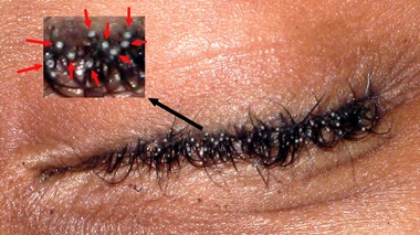 Poux de cils : d'où viennent-ils et comment s'en débarrasser ?