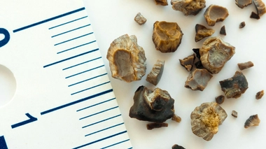 Êtes-vous incollable sur les calculs rénaux ?