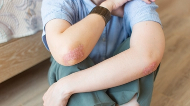 Psoriasis : existe-t-il des traitements naturels ?