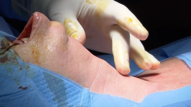 Hyperthyroïdie : une chirurgie sans cicatrice, c’est possible !