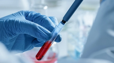 Surcharge en fer : mieux dépister l'hémochromatose