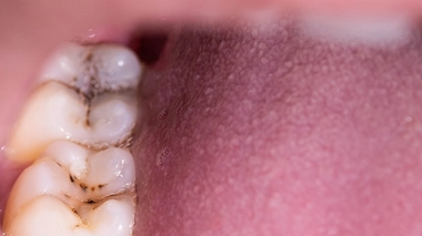 Carie dentaire : pourquoi les boulangers sont plus touchés