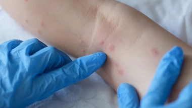 Variole du singe : que sait-on ?