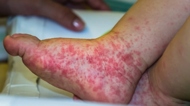 Qu'est-ce que la grippe de la tomate, ce nouveau virus découvert en Inde ?