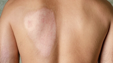 Comment est née la greffe de peau ?