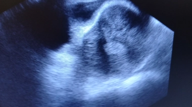 Fibromes utérins : des tumeurs bénignes