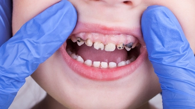 "Bébés Coca" : ce phénomène qui préoccupe les dentistes