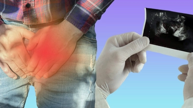 Adénome de la prostate : fréquent mais bénin