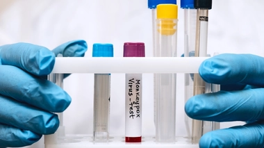 Variole du singe : quels sont les symptômes ?