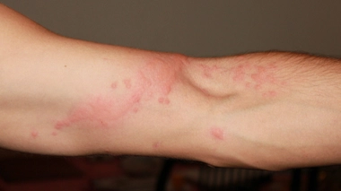 Non, uriner sur sa piqûre n'apaise pas la douleur